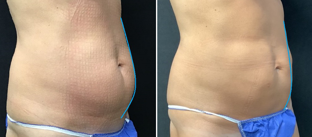 48 Year Old Female 3 Cycles to Abs Before (left) – 90 Days Post With No Weight Loss (right)