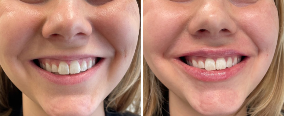 Pre Lip Filler (left) - Post Lip Filler (right)