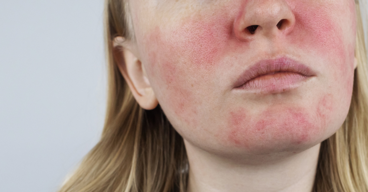 National Rosacea Awareness Month: Symptoms and Treatment Options