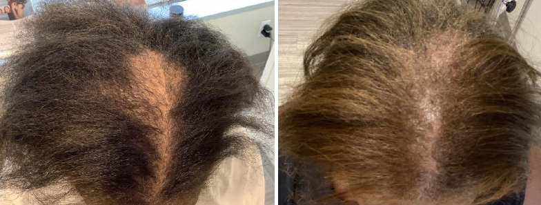 Pre PRP Sessions (left) - Post 3 PRP Sessions (right)