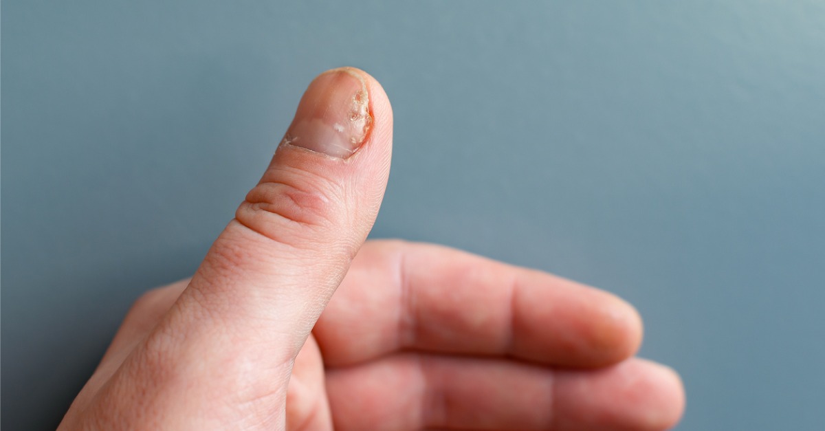 Illustration of a fungal nail infection showing human hand with  onychomycosis and close-up view of Epidermophyton floccosum fungi, one of  the causative agents of nail infections Stock Photo - Alamy