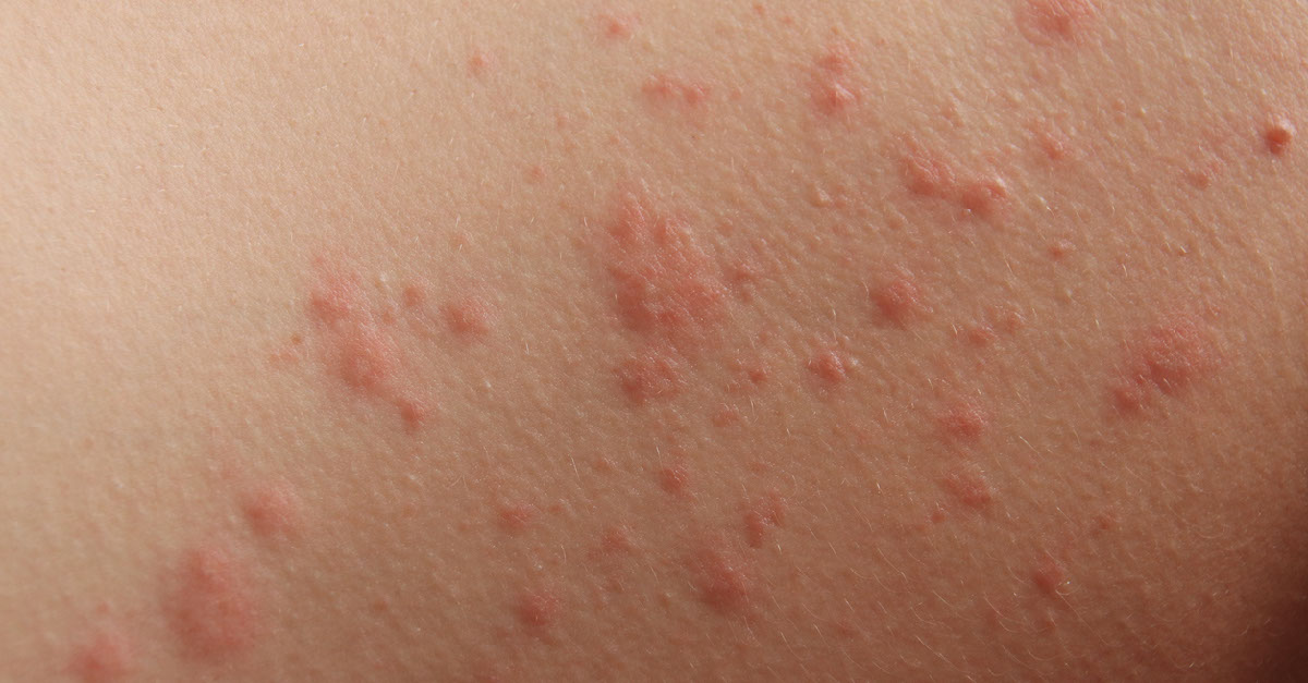 Skin rash | Mumsnet