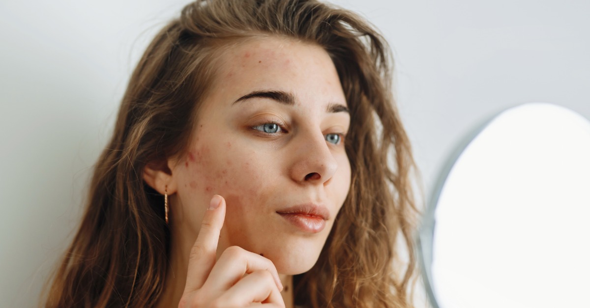 Acne Solutions and Treatment Options for Spring