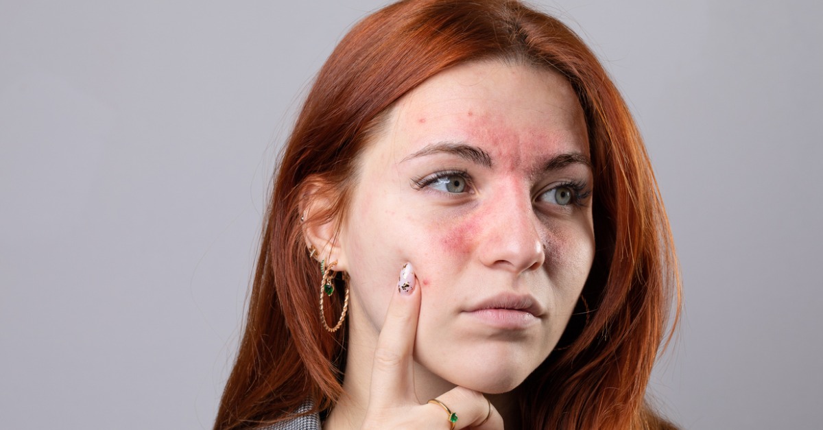 How to Manage Rosacea in the Summer