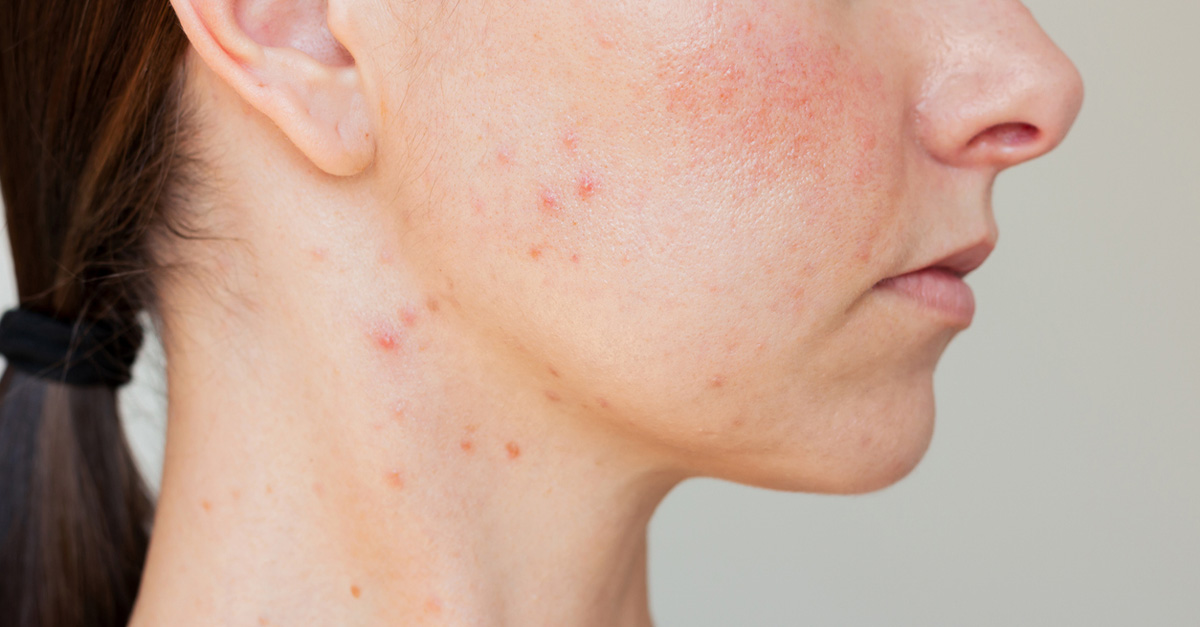 Everyday Habits & Triggers That Could Be Making Your Rosacea Worse
