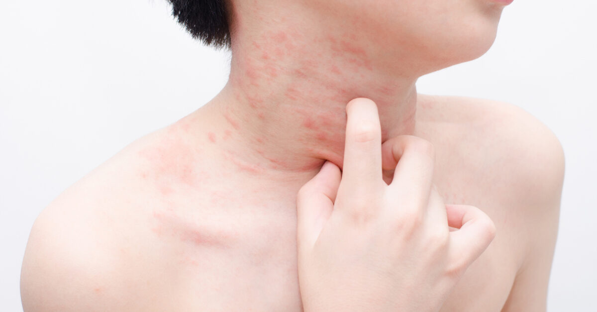 A Parent’s Guide to Recognizing and Treating Hives and Heat Rashes This Summer