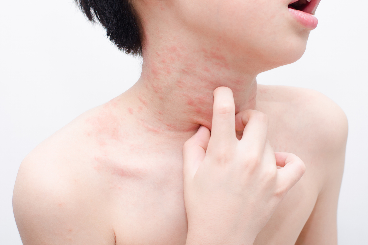 child skin with rash